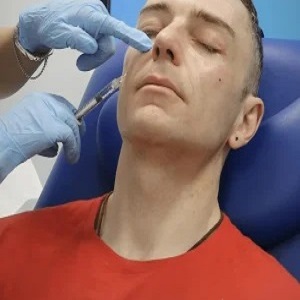 cheek-bone-filler-injection-ژل گونه
