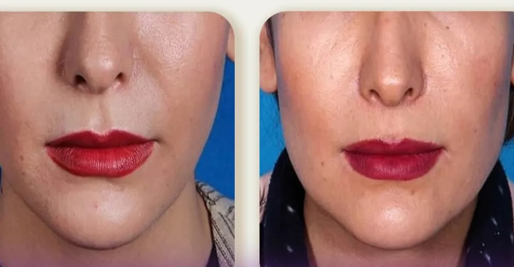 How-long-does-facial-angulation-with-filler-injection-last قبل و بعد زاویه سازی