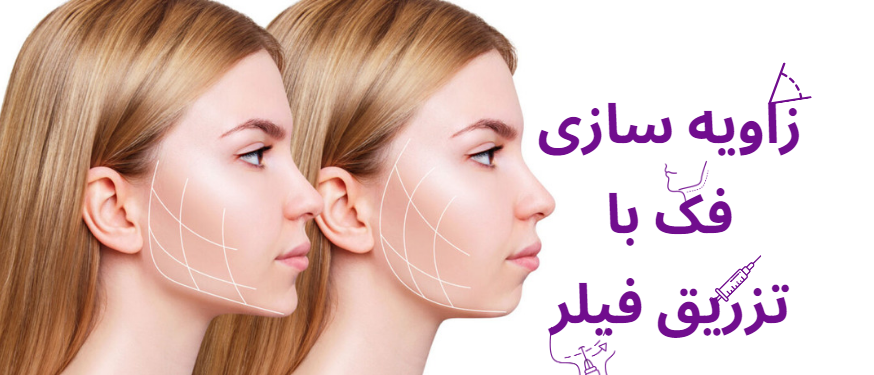 بهترین کلینیک و دکتر زاویه سازی فک با تزریق ژل در کرج