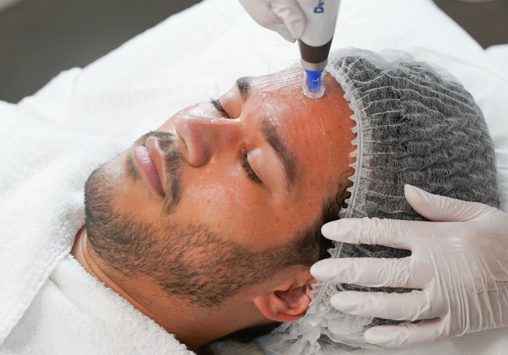 Microneedling-میکرونیدلینگ آقایان