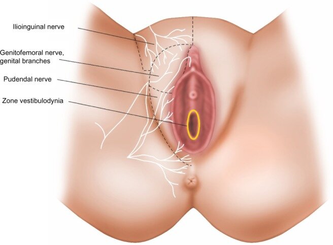 Topography-of-neuropathic-type-chronic-vulvar-painعلامت هشداردهنده