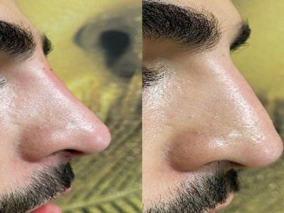 روش فرم دهی بینی بدون عمل جراحی