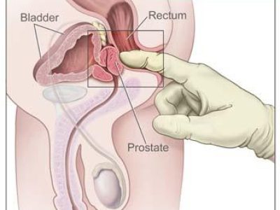 prostate_massage